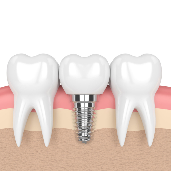 swelling-after-dental-implant